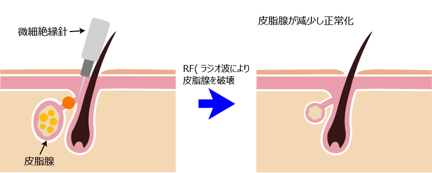 皮脂腺が減少し正常化