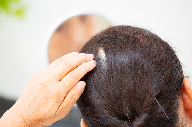 円形脱毛症とは