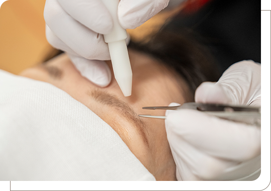 針脱毛にも対応可能 毛質に合わせた終わりのある脱毛治療を