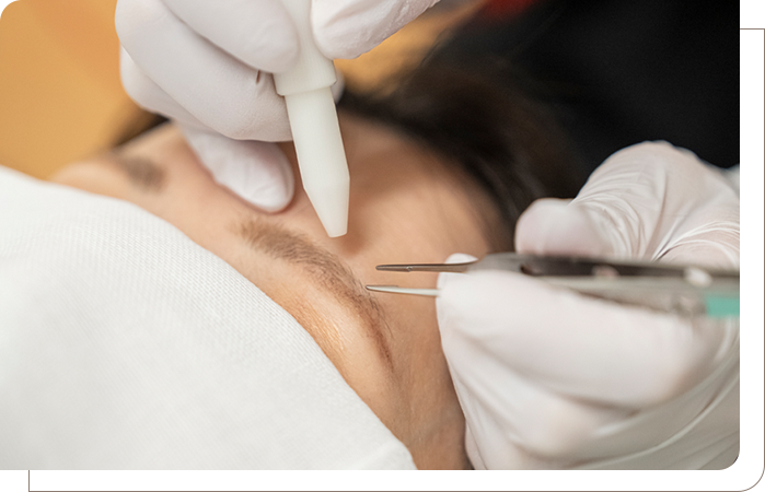 針脱毛にも対応可能 毛質に合わせた終わりのある脱毛治療を