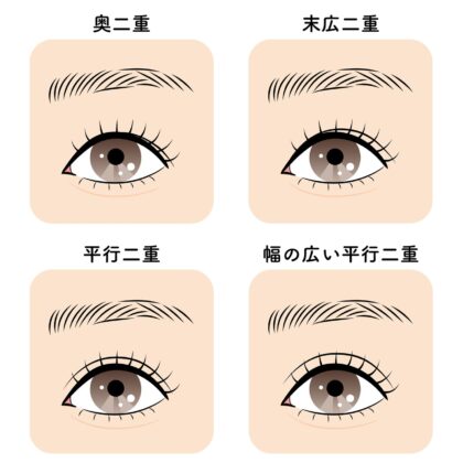 二重まぶたの主な種類