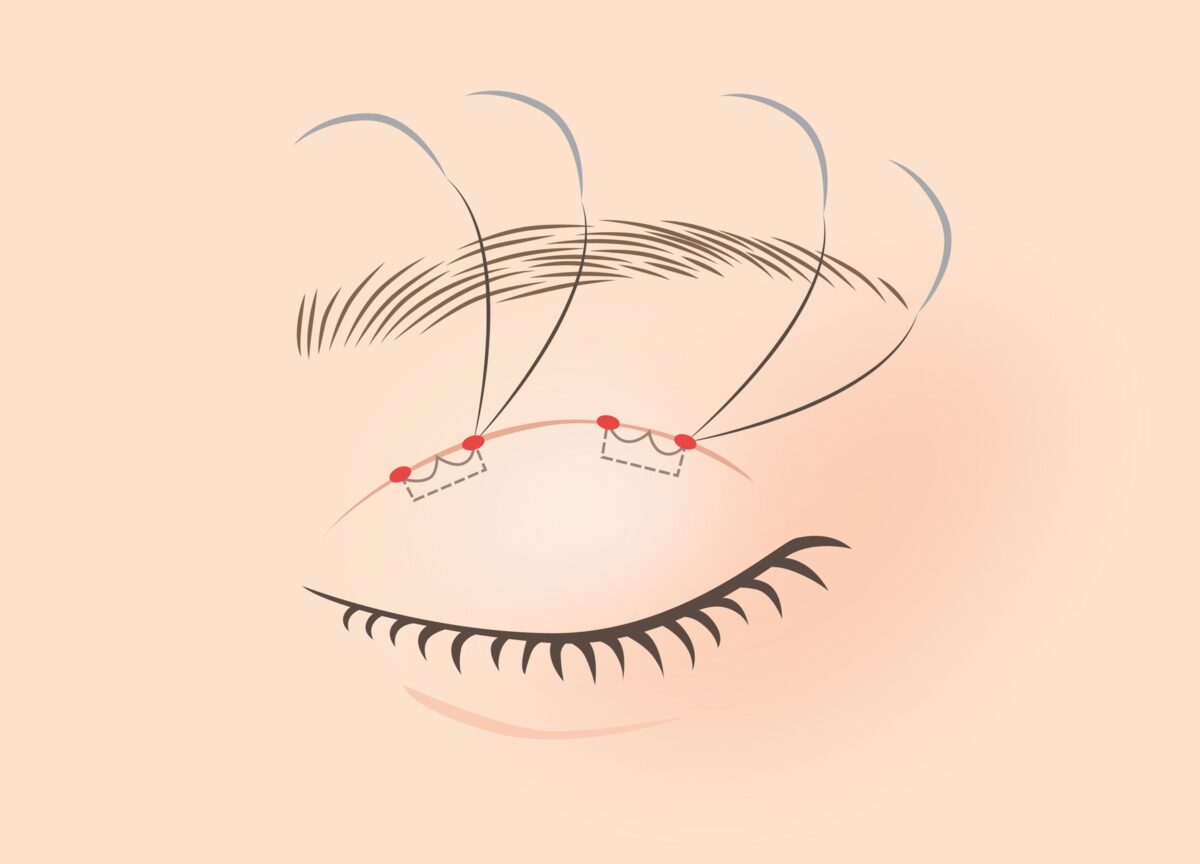 糸を取れば元に戻せる「埋没法」