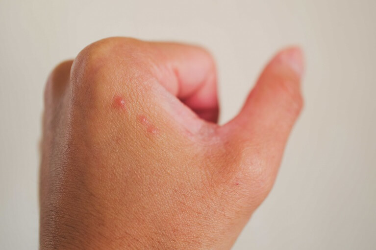 どうやってうつる？ヘルペスの原因