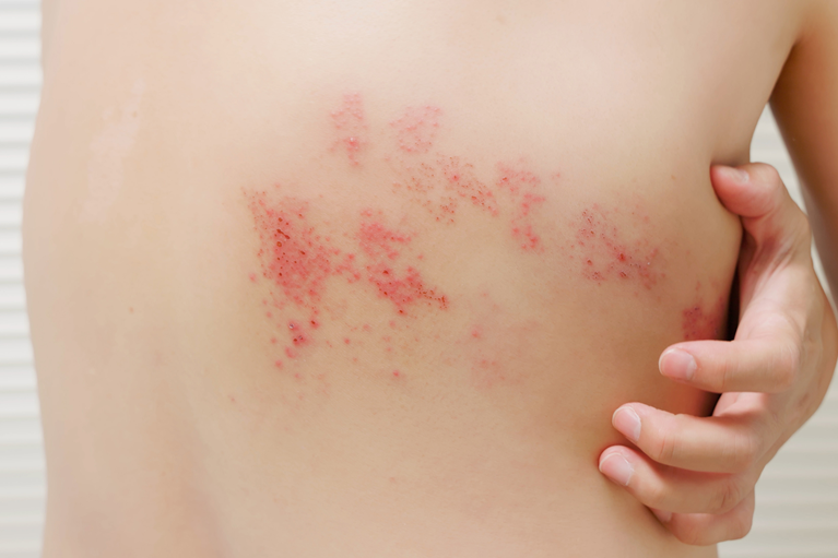 帯状疱疹の初期症状