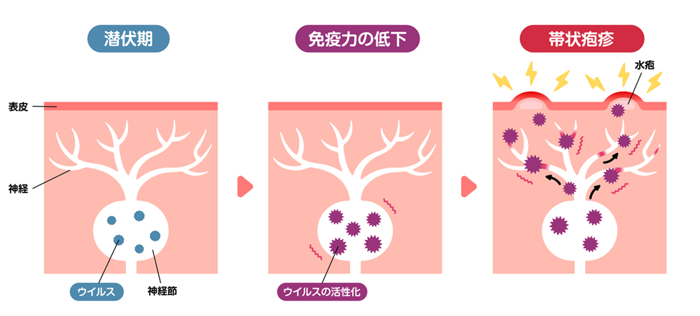 帯状疱疹の原因