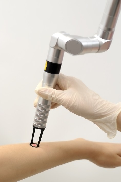 入れ墨除去のレーザー治療