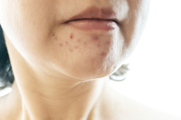 ニキビ跡は自然に治る？