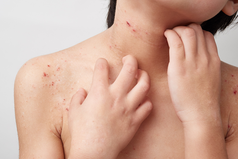 アトピー性皮膚炎