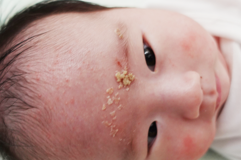 乳児脂漏性湿疹