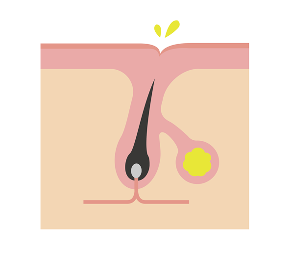 過剰な皮脂分泌