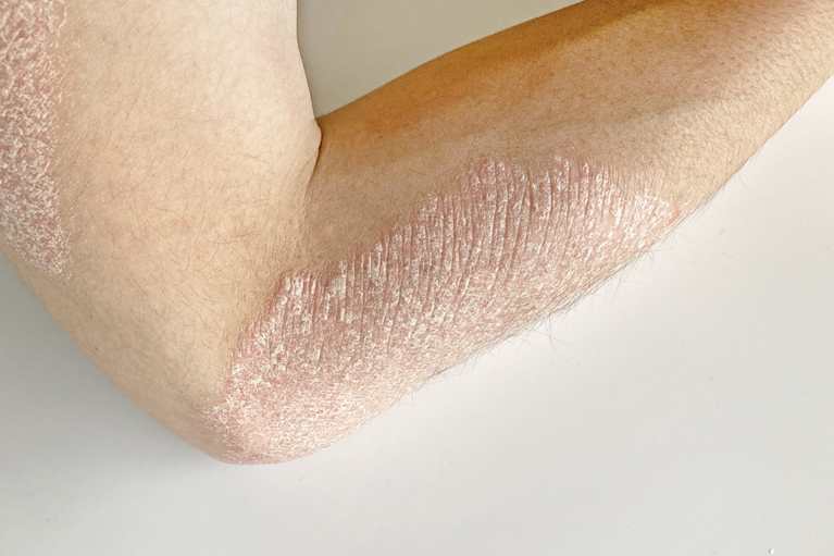 乾癬はかゆい？初期症状をチェック